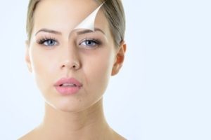 microneedling for acne scars